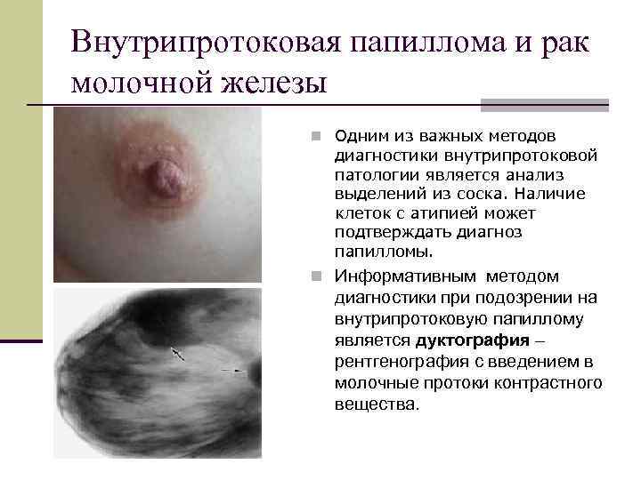 Внутрипротоковая папиллома и рак молочной железы    n Одним из важных методов