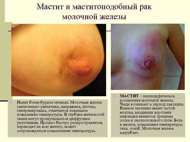    Мастит и маститоподобный рак    молочной железы  