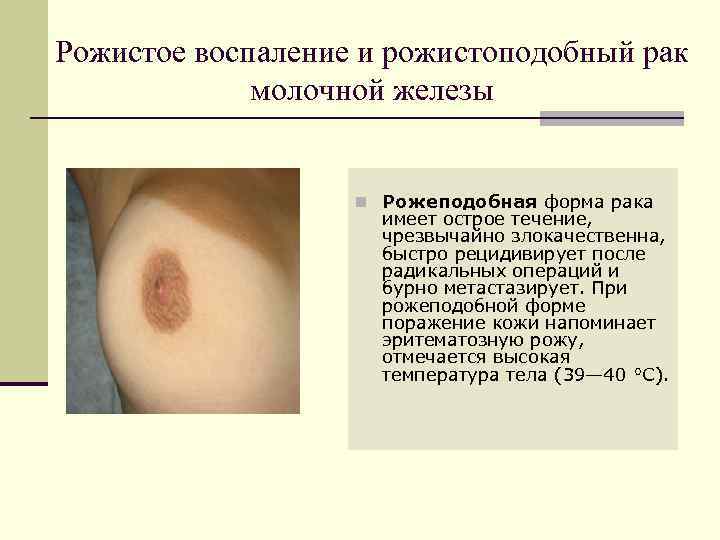 Рожистое воспаление и рожистоподобный рак   молочной железы     n