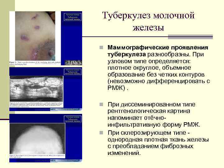 Туберкулез молочной  железы n Маммографические проявления  туберкулеза разнообразны. При  узловом типе
