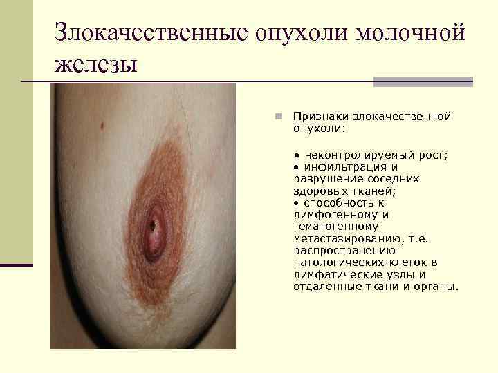 Злокачественные опухоли молочной железы   n  Признаки злокачественной    