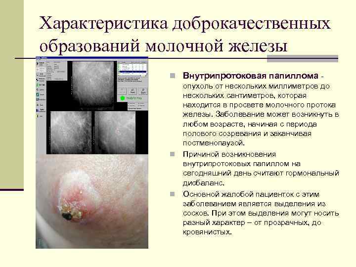 Характеристика доброкачественных образований молочной железы    n Внутрипротоковая папиллома -  