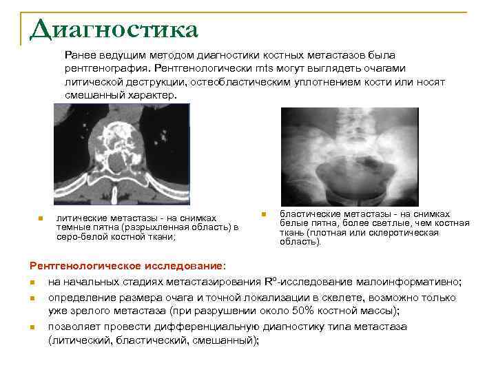 Диагностика Ранее ведущим методом диагностики костных метастазов была рентгенография. Рентгенологически mts могут выглядеть очагами