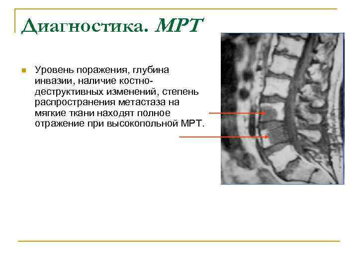 Диагностика. МРТ n Уровень поражения, глубина инвазии, наличие костно- деструктивных изменений, степень распространения метастаза