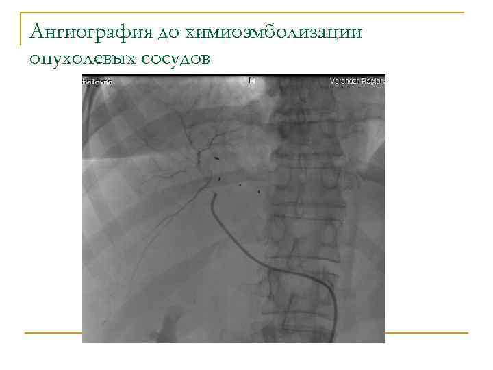 Ангиография до химиоэмболизации опухолевых сосудов 