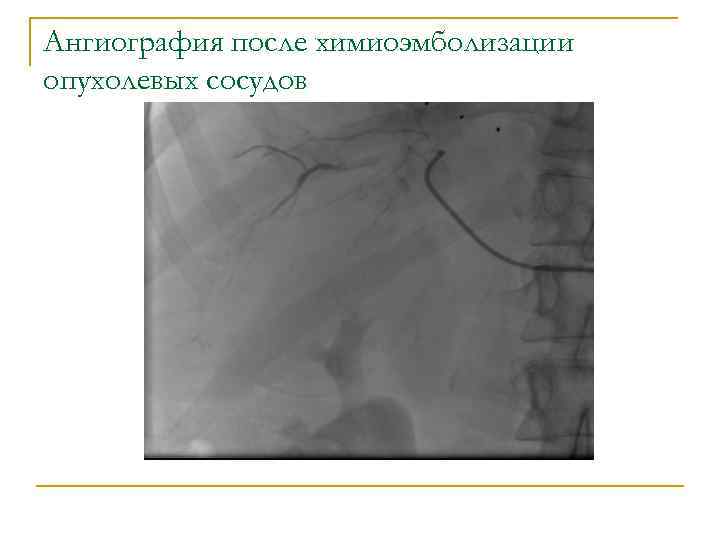 Ангиография после химиоэмболизации опухолевых сосудов 