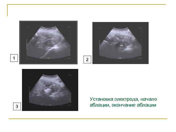 1 2 Установка электрода, начало 3 аблации, окончание аблации 