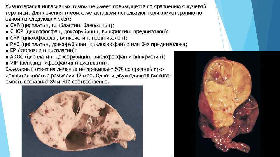 Химиотерапия инвазивных тимом не имеет преимуществ по сравнению с лучевой терапией. Для лечения тимом