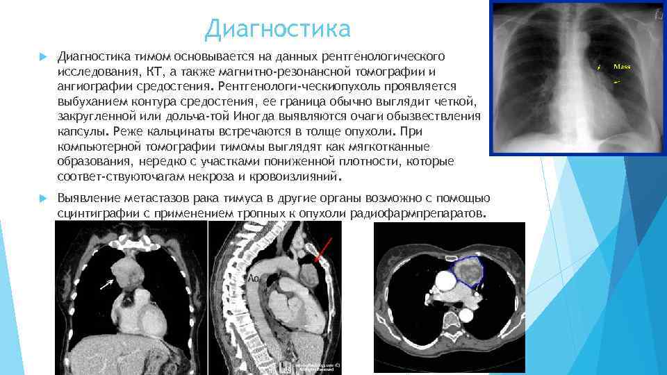  Диагностика тимом основывается на данных рентгенологического исследования, КТ, а также магнитно-резонансной томографии и