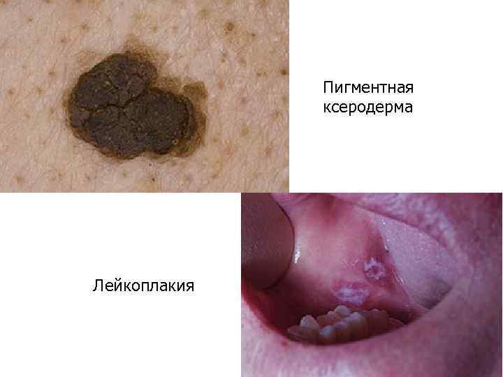  • В желудке • - хронические анацидные и очаговые  гастриты,  •