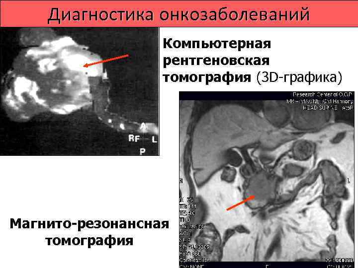  Чрескожная трепанбиопсия под   контролем УЗИ Х 25   Биоптат –