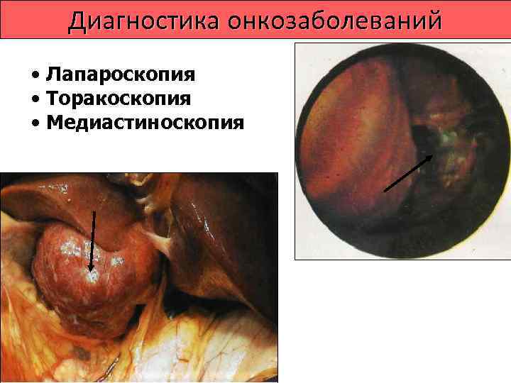    Лечение опухолей •  Радикальное - лечение, которое направлено на полную