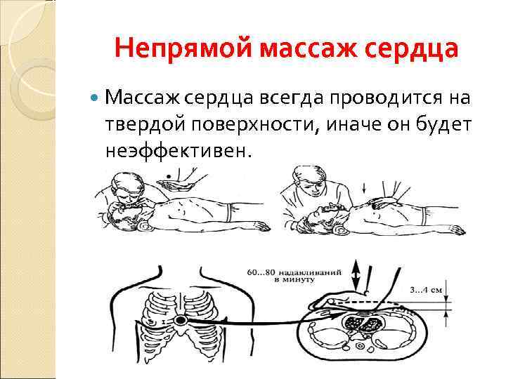  Непрямой массаж сердца  Массаж сердца всегда проводится на твердой поверхности, иначе он