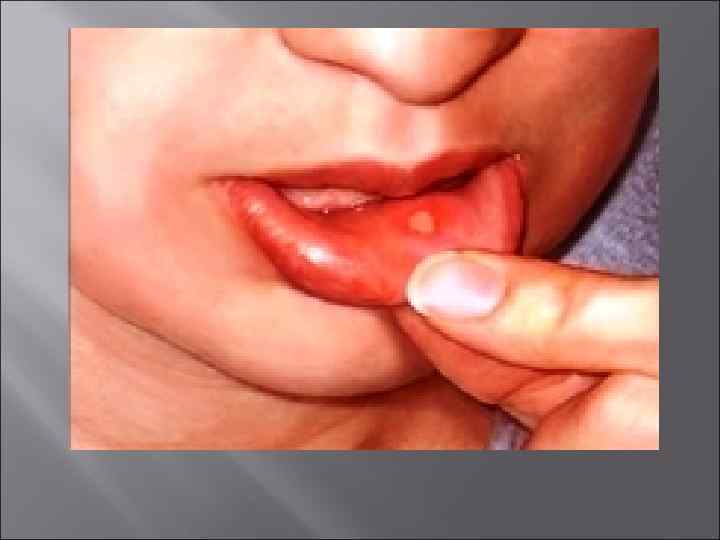  • Главная проблема лечения стафилококковых инфекций – высокая лекарственная   устойчивость. 