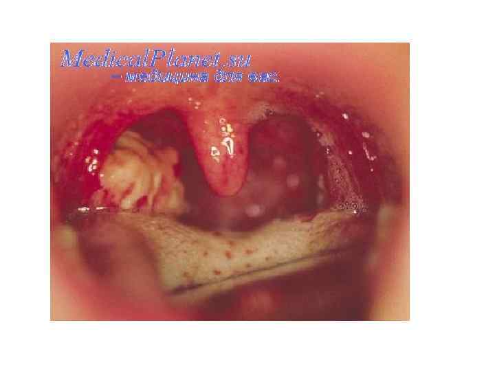   Принципы лечения  стафилококковых инфекций 1. Антибиотики; 2. Стафилококковый бактериофаг (при локализованных