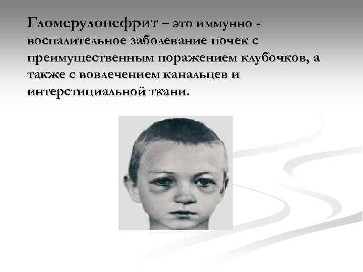 Гломерулонефрит – это иммунно - воспалительное заболевание почек с преимущественным поражением клубочков, а также