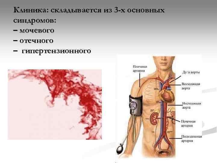 Клиника: складывается из 3 -х основных синдромов: – мочевого – отечного – гипертензионного 