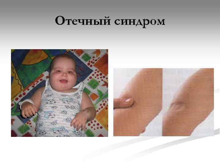 Отечный синдром 