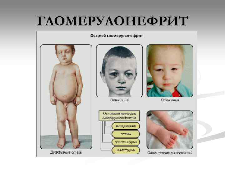 ГЛОМЕРУЛОНЕФРИТ 