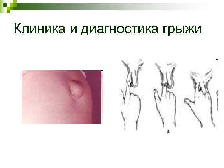 Клиника и диагностика грыжи Клиника и диагностика грыжи
