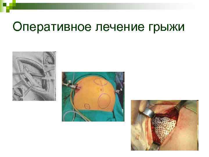 Оперативное лечение грыжи Оперативное лечение грыжи