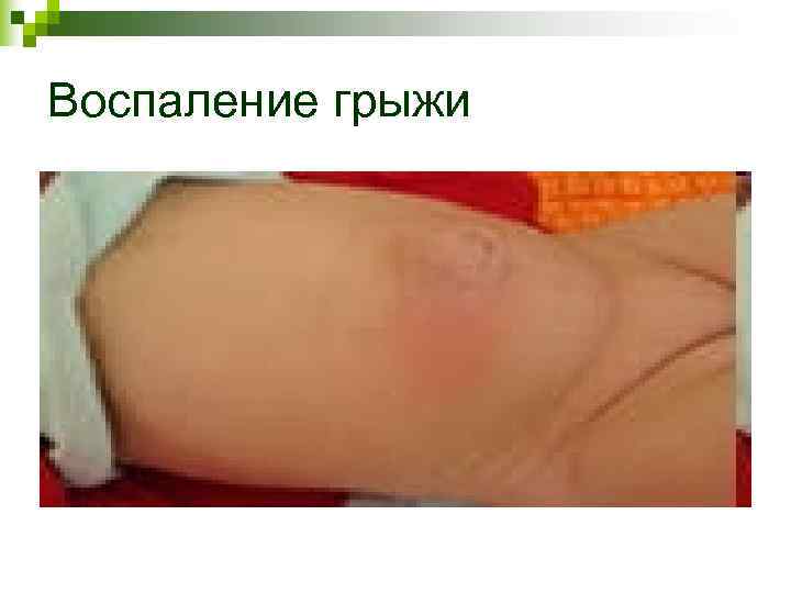 Воспаление грыжи Воспаление грыжи