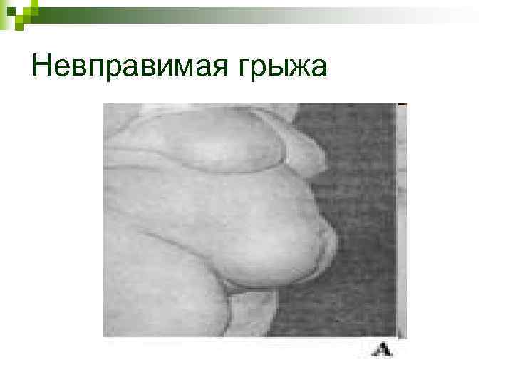 Невправимая грыжа Невправимая грыжа