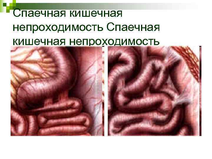 Спаечная кишечная непроходимость Спаечная кишечная непроходимость