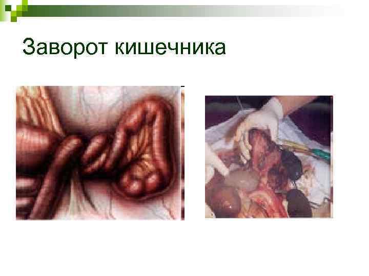 Заворот кишечника Заворот кишечника