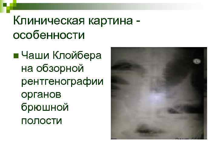 Клиническая картина - особенности n Чаши Клойбера на обзорной рентгенографии органов брюшной полости Клиническая картина - особенности n Чаши Клойбера на обзорной рентгенографии органов брюшной полости