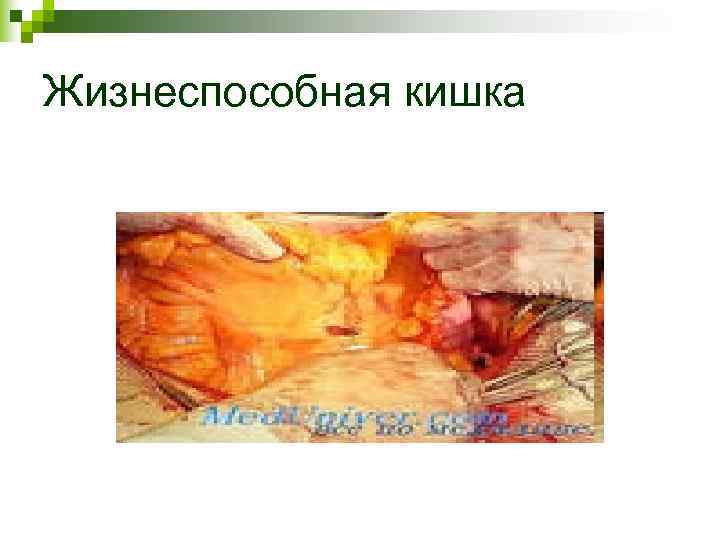 Жизнеспособная кишка Жизнеспособная кишка