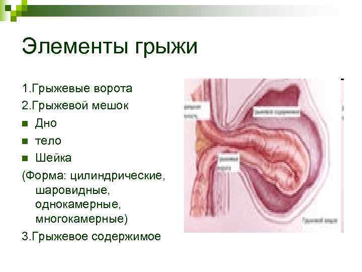 Элементы грыжи 1. Грыжевые ворота 2. Грыжевой мешок n Дно n тело n Шейка Элементы грыжи 1. Грыжевые ворота 2. Грыжевой мешок n Дно n тело n Шейка