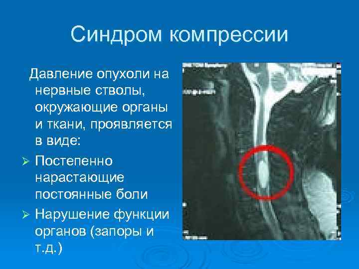  Синдром компрессии Давление опухоли на нервные стволы, окружающие органы и ткани, проявляется в