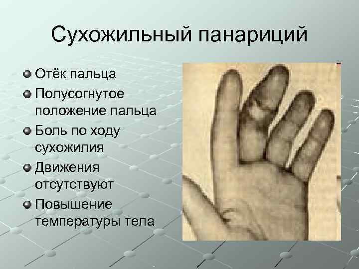  Сухожильный панариций Отёк пальца Полусогнутое положение пальца Боль по ходу сухожилия Движения отсутствуют