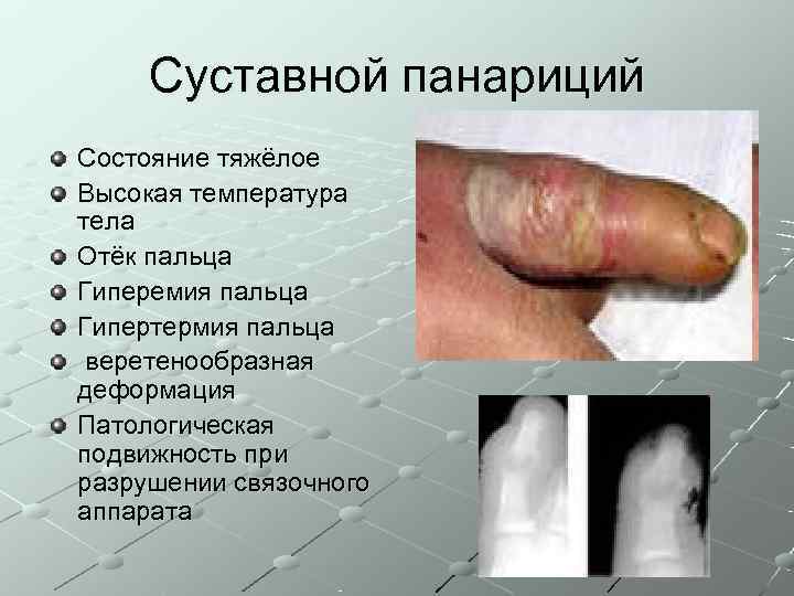  Суставной панариций Состояние тяжёлое Высокая температура тела Отёк пальца Гиперемия пальца Гипертермия пальца