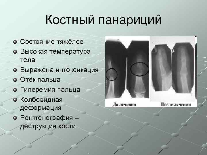  Костный панариций Состояние тяжёлое Высокая температура тела Выражена интоксикация Отёк пальца Гиперемия пальца
