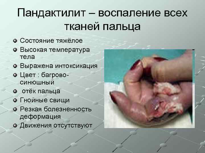 Пандактилит – воспаление всех  тканей пальца Состояние тяжёлое Высокая температура тела Выражена интоксикация
