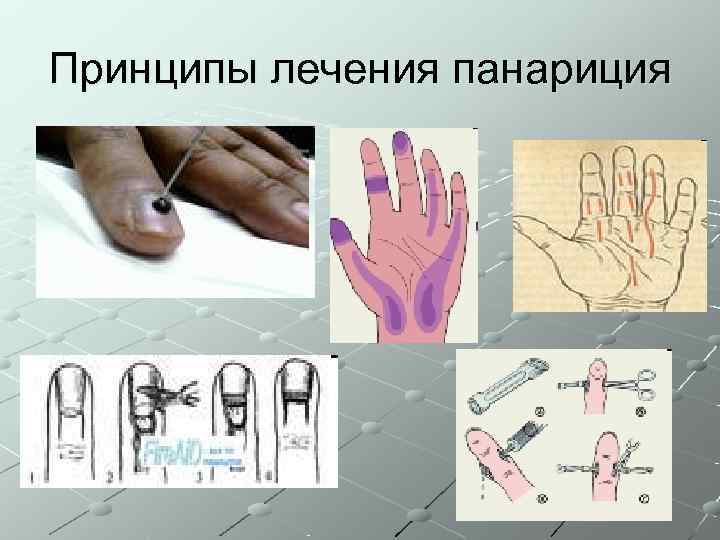 Принципы лечения панариция 