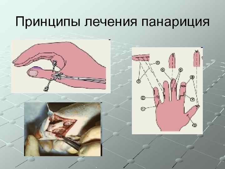 Принципы лечения панариция 