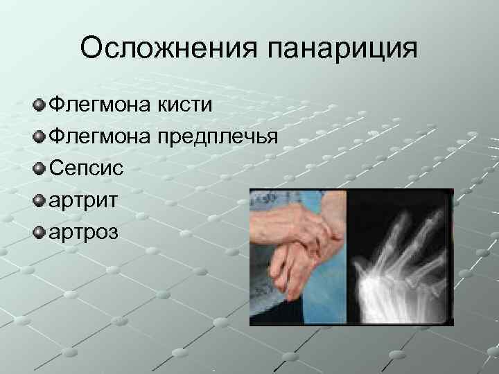  Осложнения панариция Флегмона кисти Флегмона предплечья Сепсис артрит артроз 