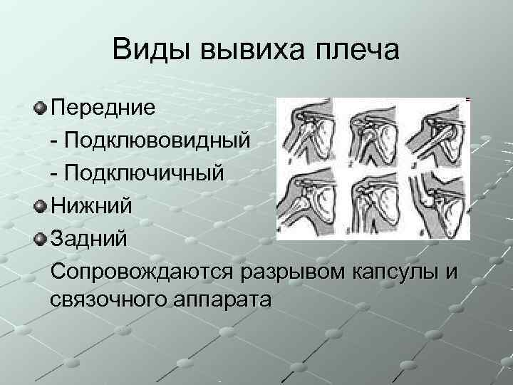   Виды вывиха плеча Передние - Подклювовидный - Подключичный Нижний Задний Сопровождаются разрывом