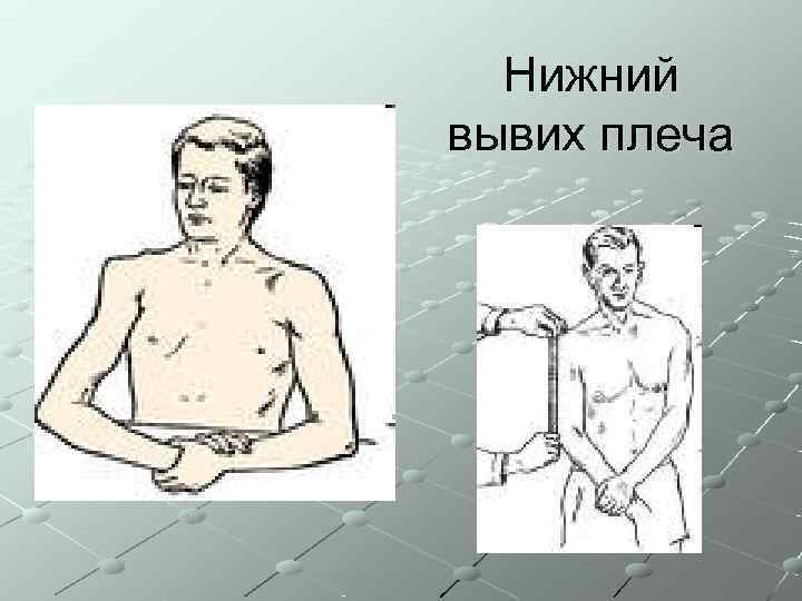  Нижний вывих плеча 