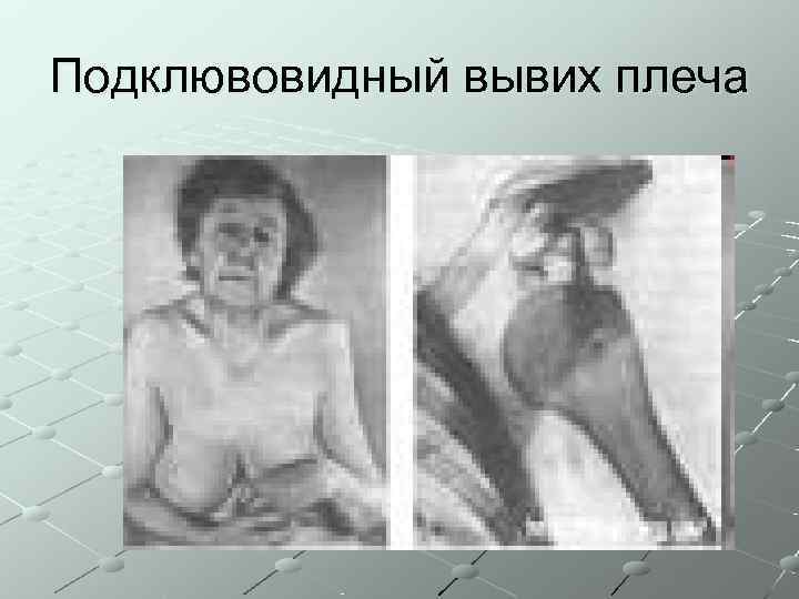 Подклювовидный вывих плеча 