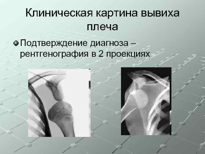  Клиническая картина вывиха  плеча Подтверждение диагноза – рентгенография в 2 проекциях 