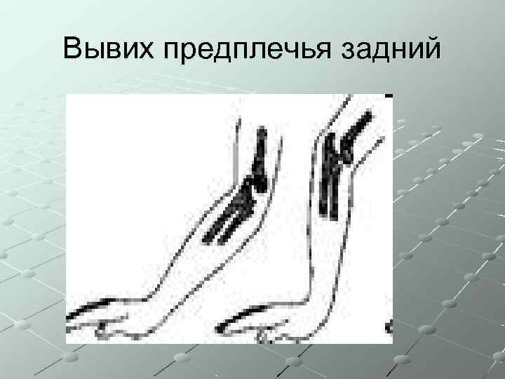 Вывих предплечья задний 