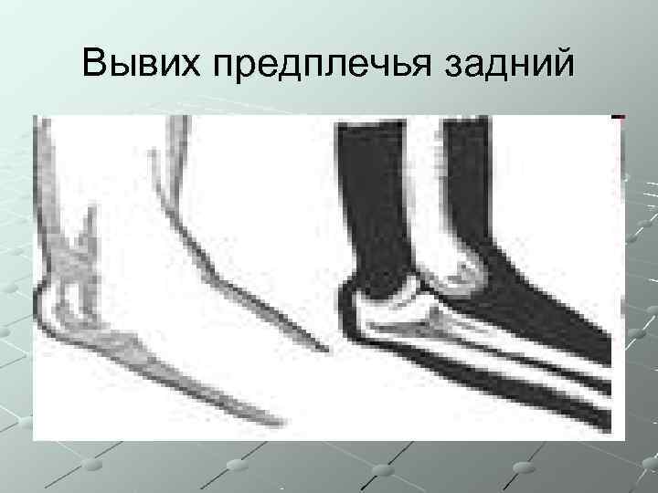 Вывих предплечья задний 