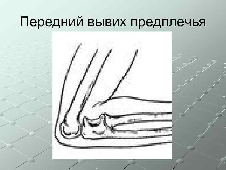 Передний вывих предплечья 