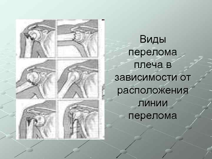  Виды  перелома плеча в зависимости от расположения линии  перелома 