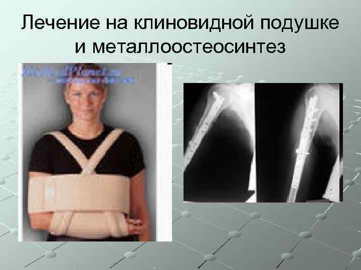 Лечение на клиновидной подушке и металлоостеосинтез 