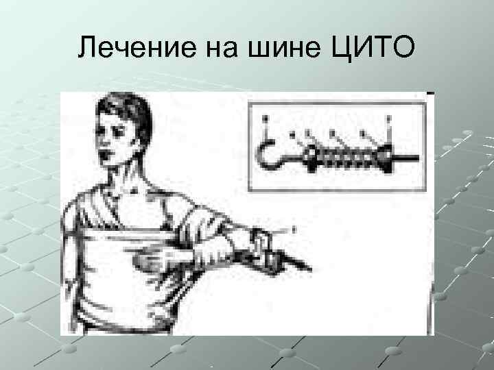 Лечение на шине ЦИТО 